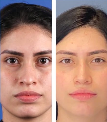 Rinoplastia caso 16 — antes y después